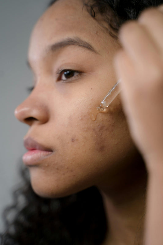 Does Niacinamide Help Acne and Acne Scars?